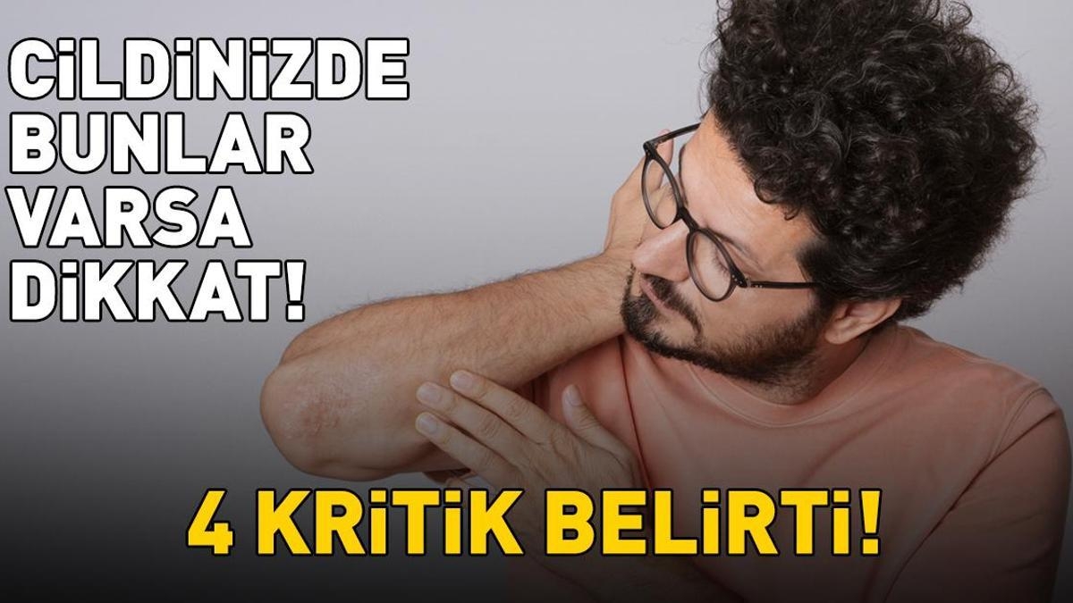 Sedef Hastalığını Ele Veren 4 Belirti! Cildinizdeki Değişimlere Dikkat